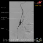 CAS filter wire protection