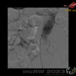 FEVAR utlösta njurgrafter