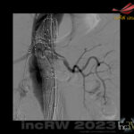 FEVAR njurartär kateterisering
