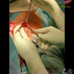 Subcutan hudficka för venport